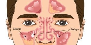 Illustration showing the anatomy of the sinuses with mucus and polyps indicated within the nasal passages.