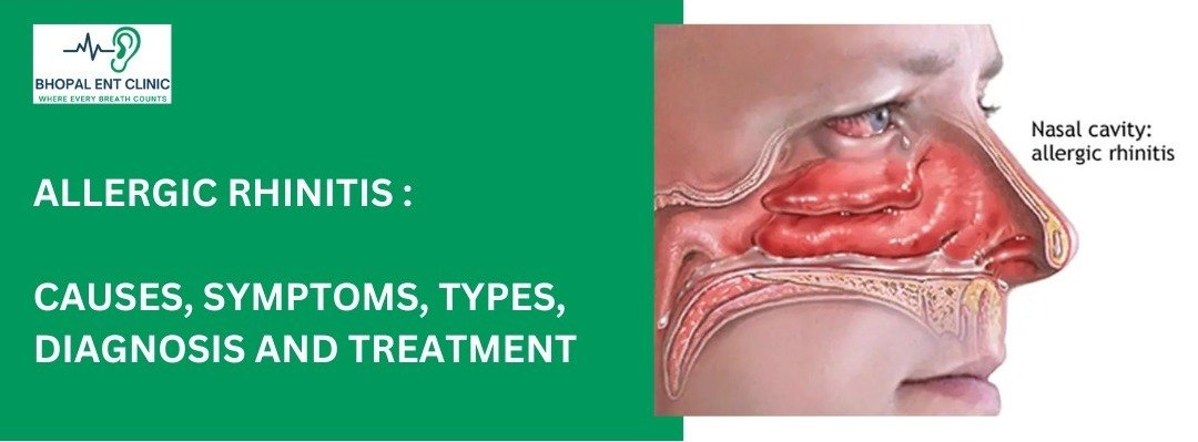 Best Allergic Rhinitis Treatment, Nasal Symptoms | Ent Clinic