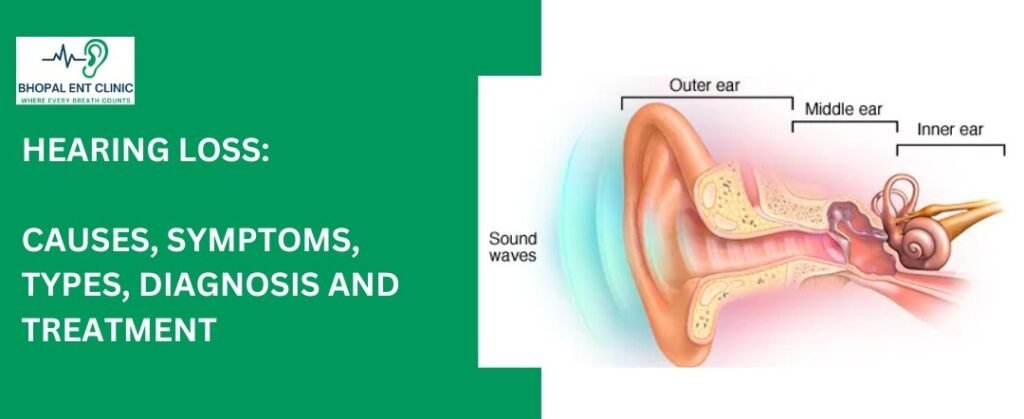 Graphic for Bhopal ENT Clinic titled "Hearing Loss: Causes, Symptoms, Types, Diagnosis and Treatment". The image includes a logo of Bhopal ENT Clinic with the slogan "Where Every Breath Counts" and an illustration of the outer, middle, and inner ear with sound waves entering the ear.