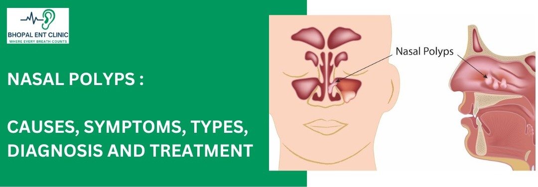 Graphic for Bhopal ENT Clinic titled "Nasal Polyps: Causes, Symptoms, Types, Diagnosis and Treatment". The image includes a logo of Bhopal ENT Clinic with the slogan "Where Every Breath Counts" and an illustration of nasal polyps within the nasal passages and sinuses.
