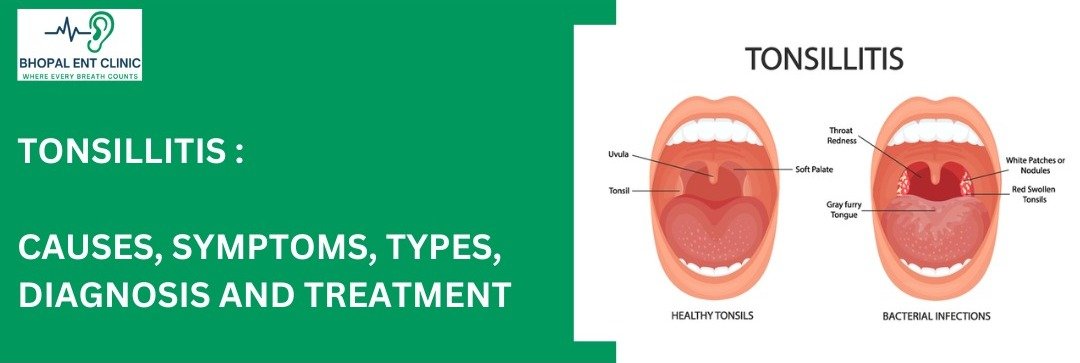 Graphic for Bhopal ENT Clinic titled "Tonsillitis: Causes, Symptoms, Types, Diagnosis and Treatment". The image includes a logo of Bhopal ENT Clinic with the slogan "Where Every Breath Counts" and an illustration comparing healthy tonsils with tonsils affected by bacterial infections.